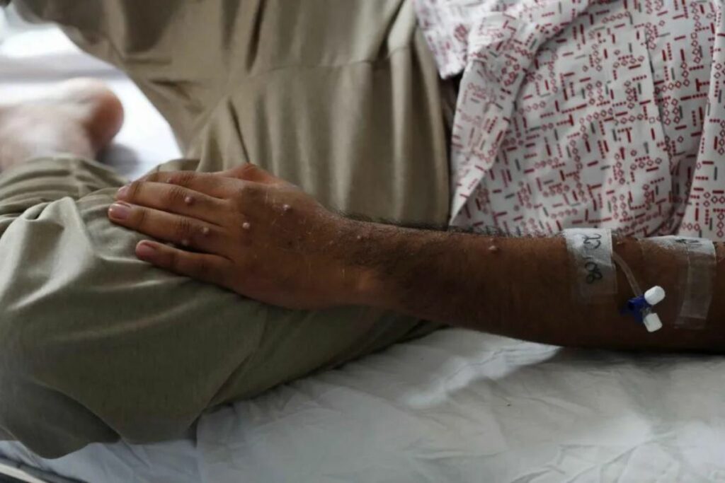 Un paciente es atendido tras ser diagnosticado con la viruela del mono.