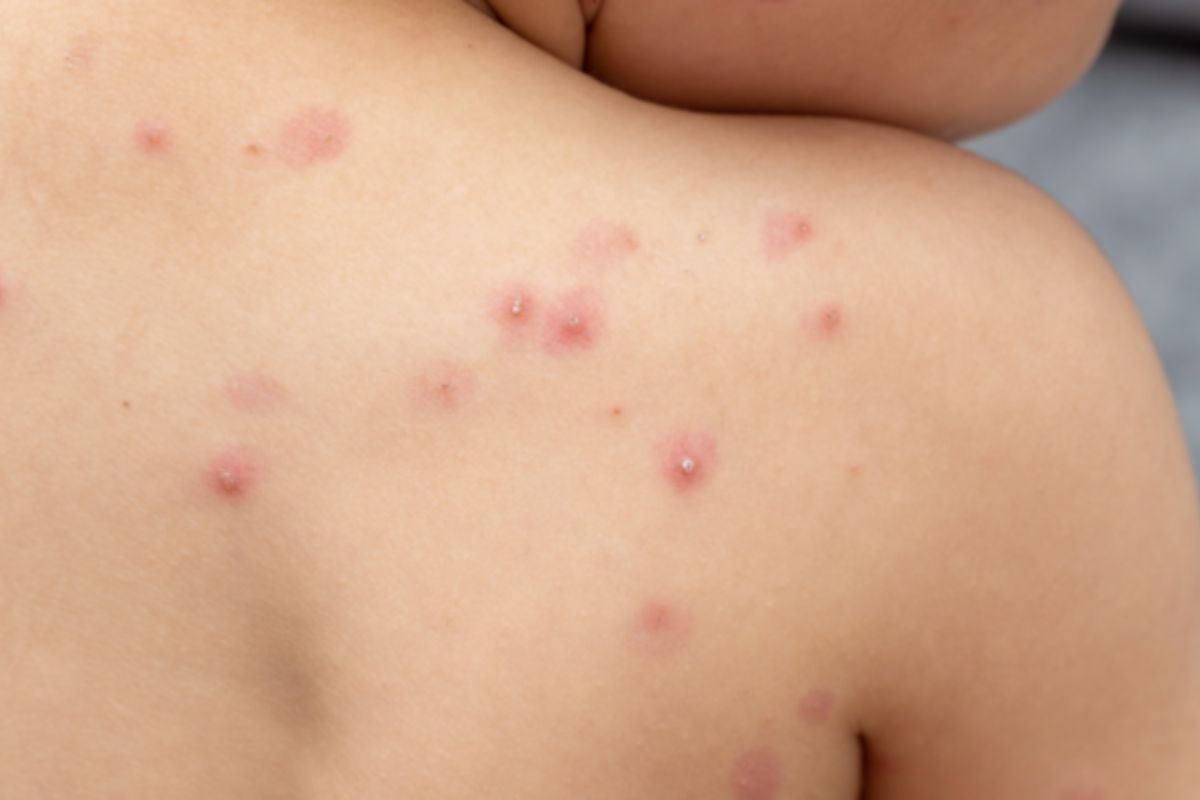 Salud confirma primer caso de variante Clado Ib de viruela símica en Ecuador