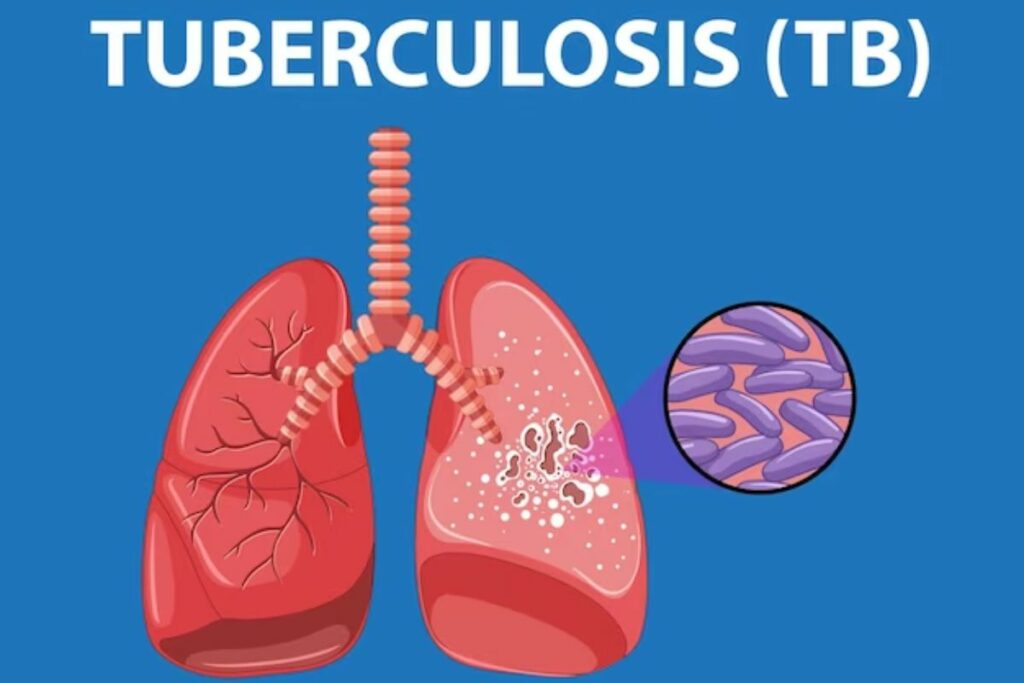 El Ministerio de Salud es el encargado del tratamiento de tuberculosis.