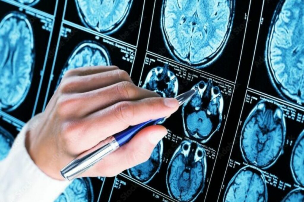 Una investigación destaca que el Alzheimer se puede detectar tempranamente.