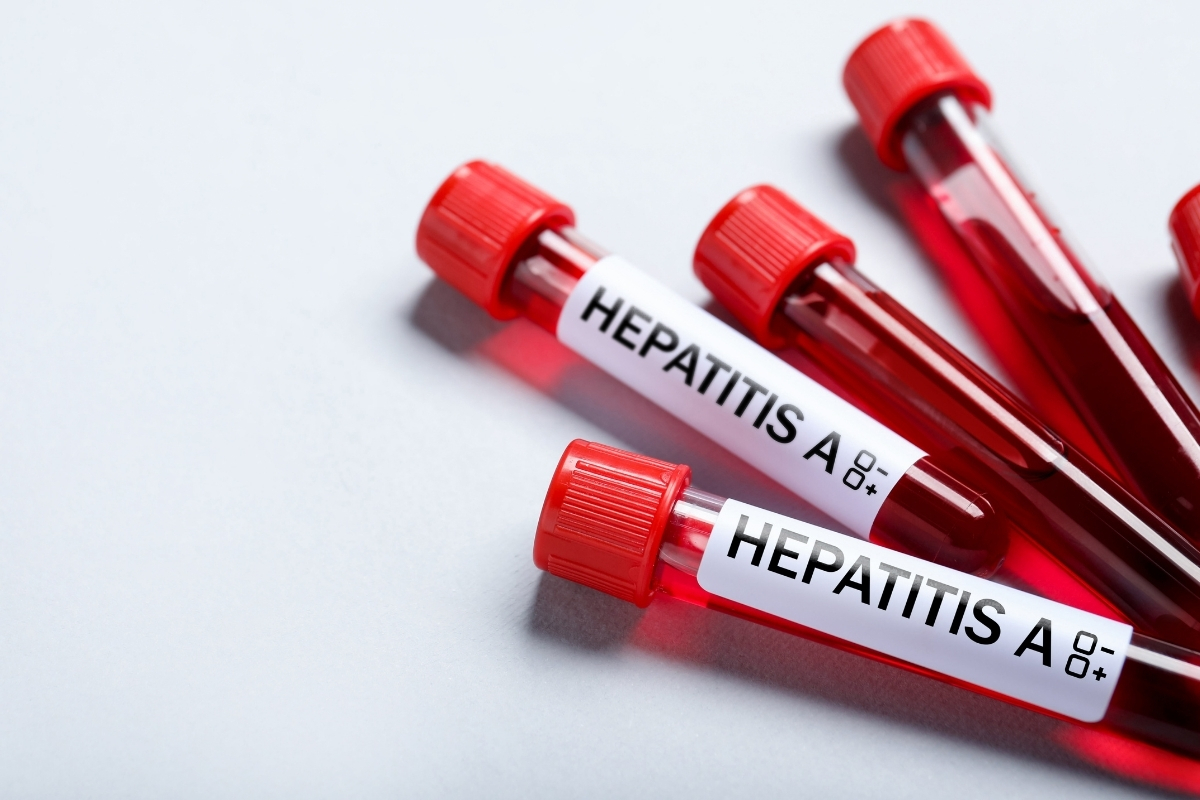 Hepatitis A en Ecuador: Brote activo provoca suspensión de clases en Quito y alarma en la Amazonía